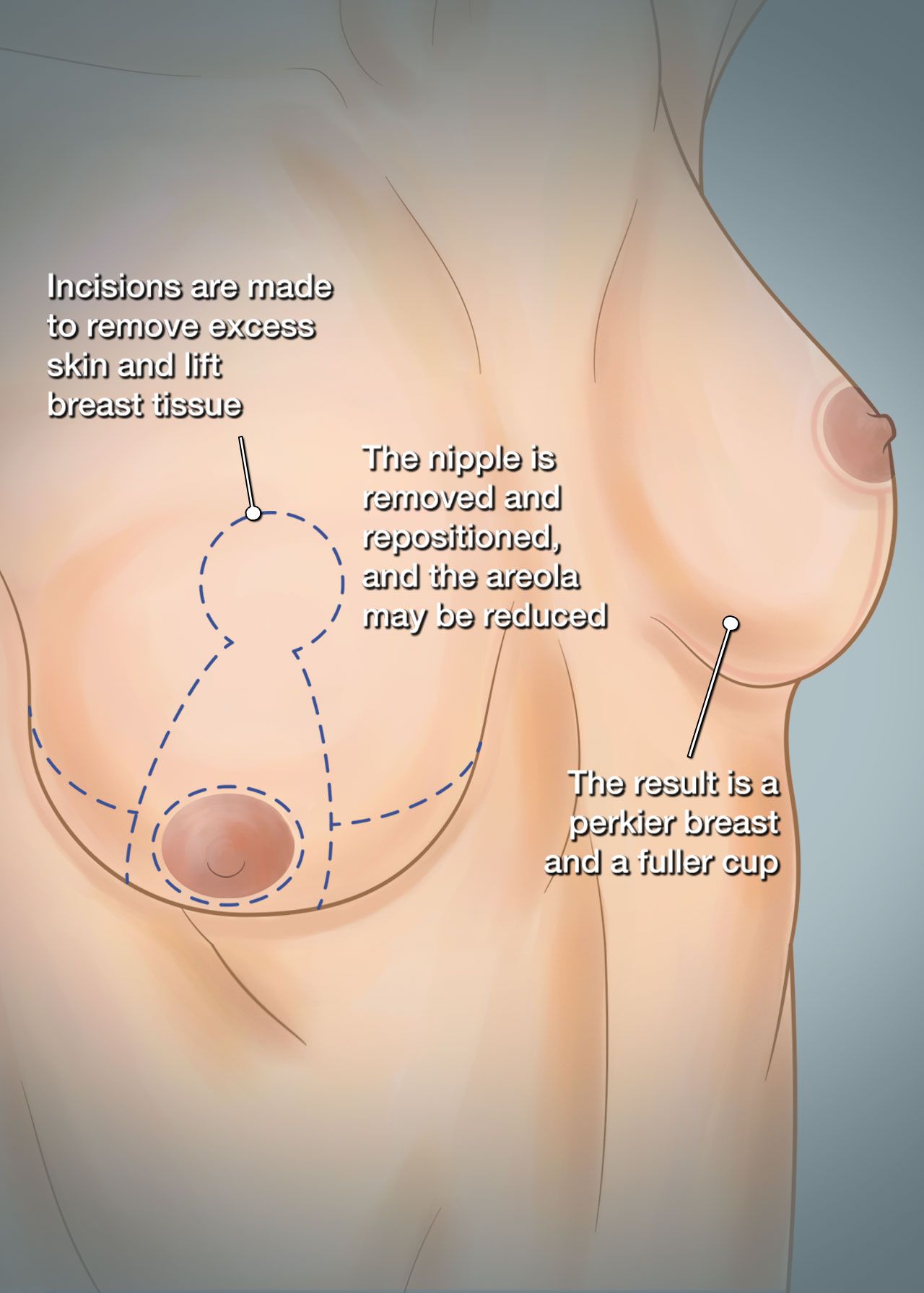 breast lift surgery