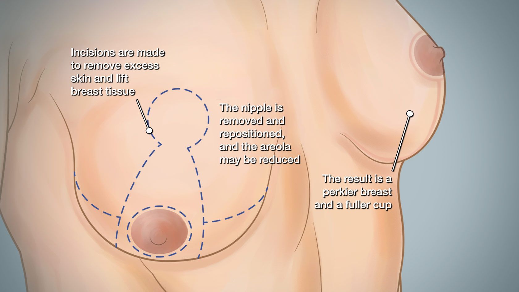 breast lift surgery