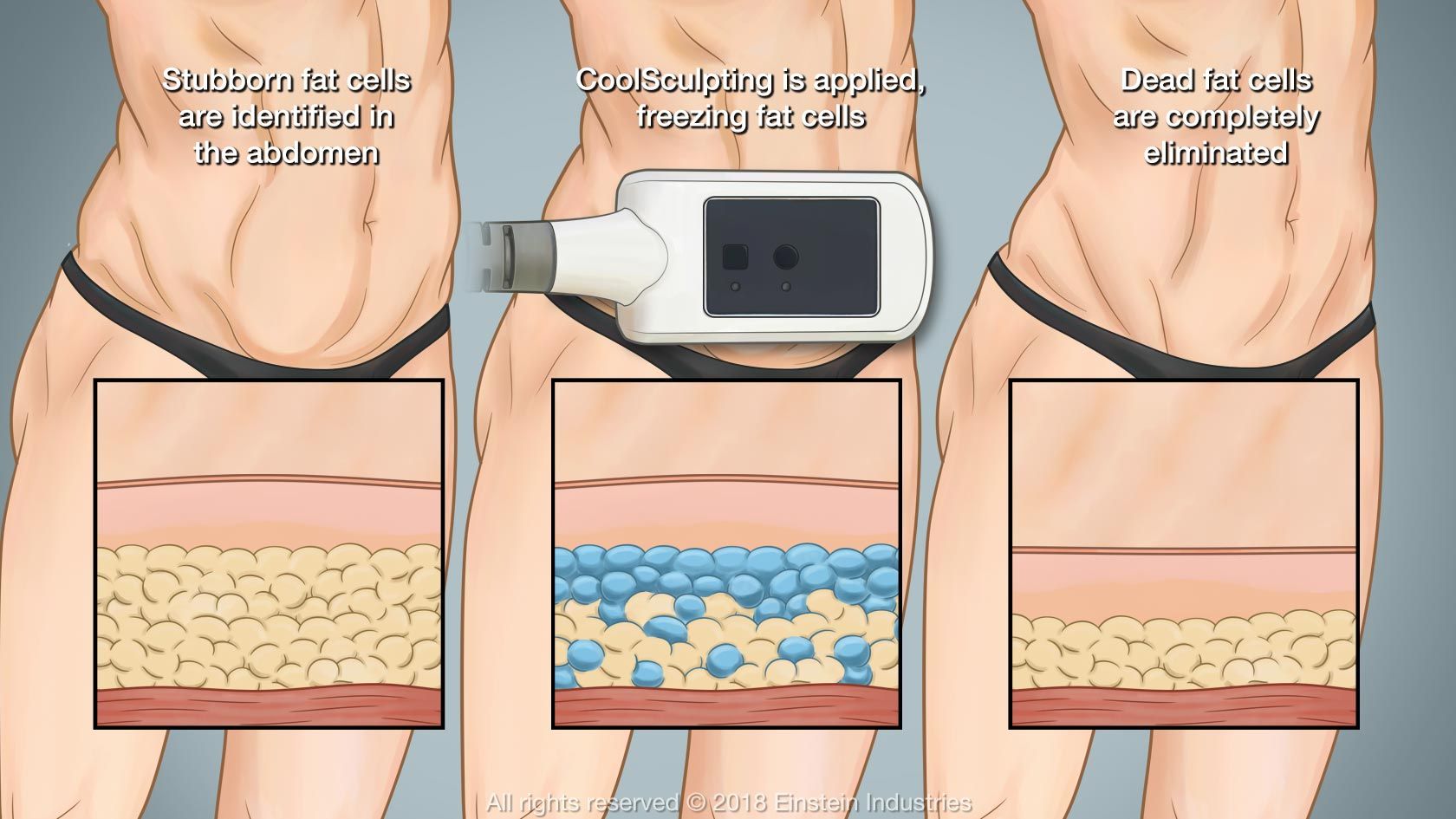 CoolSculpting procedure